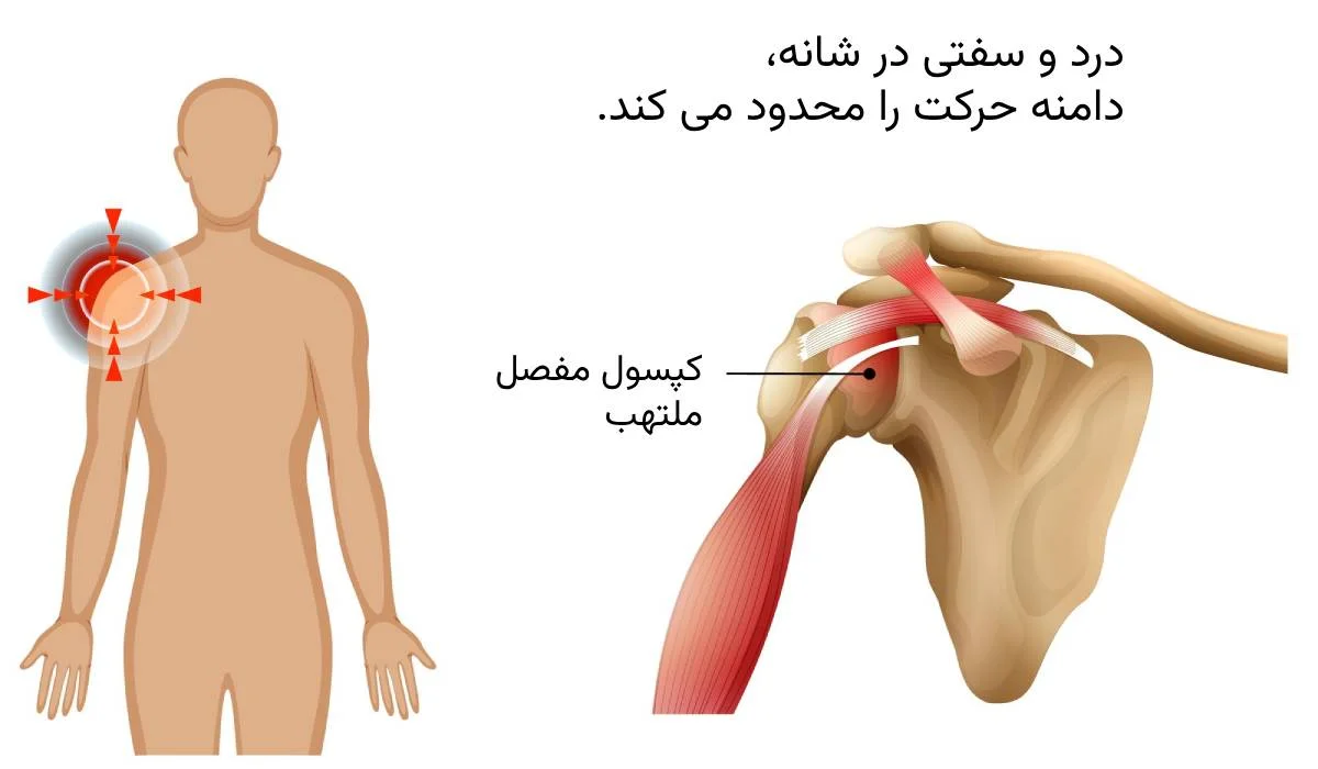 آناتومی شولدر برای علت درد قفسه سینه سمت چپ و پشت کتف