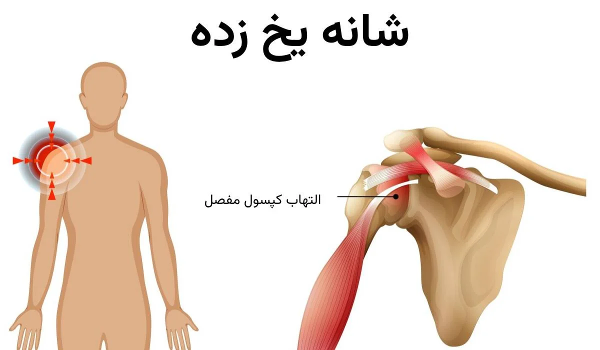 اناتومی فروزن شولدر - شانه یخ زده