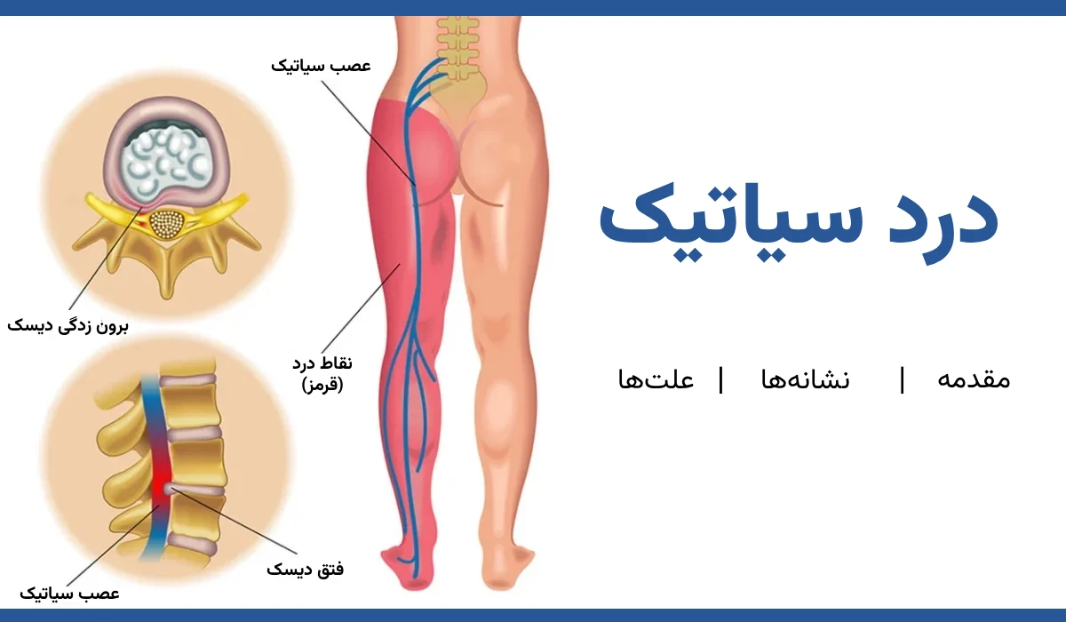 سیاتیک چیست